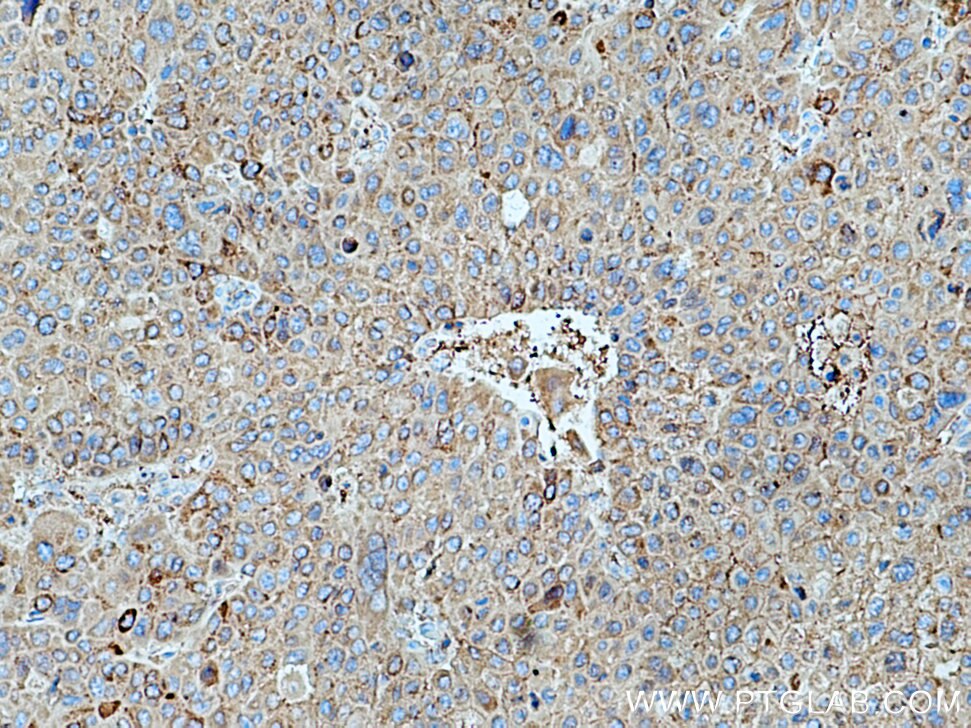 IHC staining of human liver cancer using 16382-1-AP