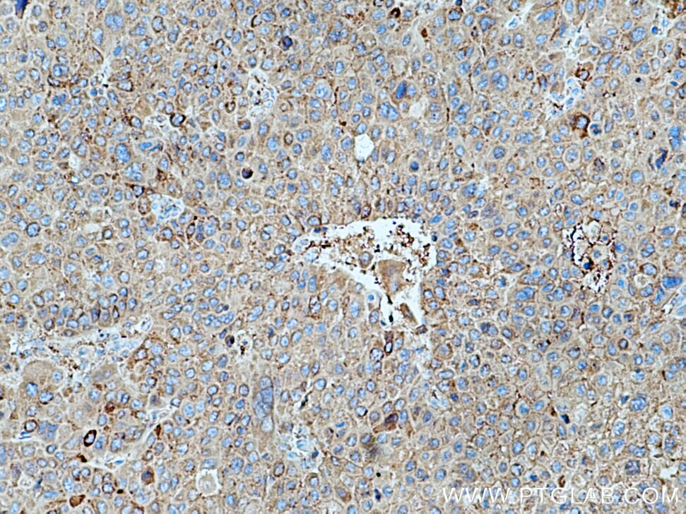 Immunohistochemistry (IHC) staining of human liver cancer tissue using Alpha 1 Antitrypsin Polyclonal antibody (16382-1-AP)