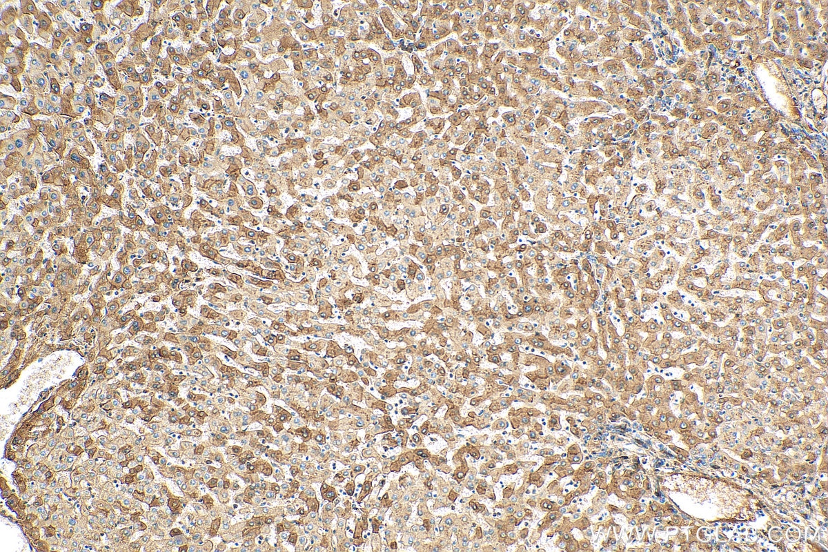 Immunohistochemistry (IHC) staining of human hepatocirrhosis tissue using Alpha 1 Antitrypsin Polyclonal antibody (16382-1-PBS)