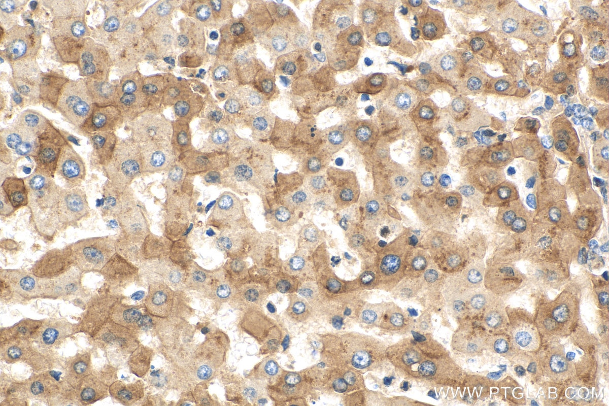 Immunohistochemistry (IHC) staining of human hepatocirrhosis tissue using Alpha 1 Antitrypsin Polyclonal antibody (16382-1-AP)