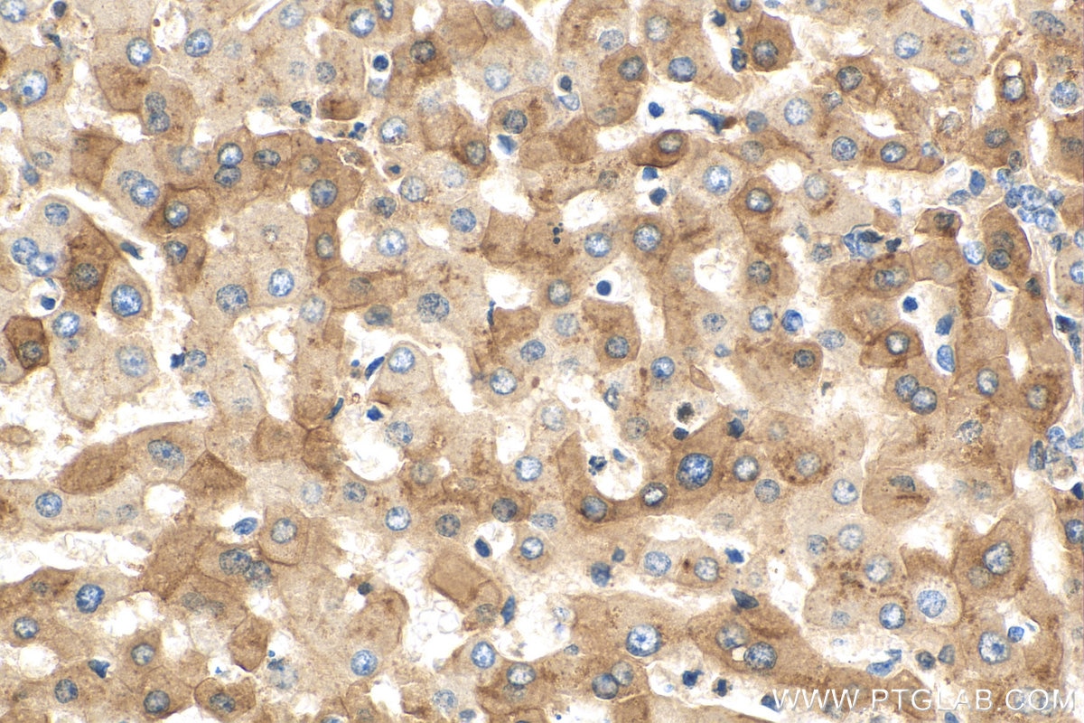 IHC staining of human hepatocirrhosis using 16382-1-PBS