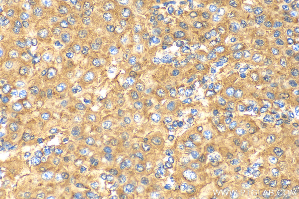 Immunohistochemistry (IHC) staining of human liver cancer tissue using Alpha 1 Antitrypsin Polyclonal antibody (16382-1-AP)