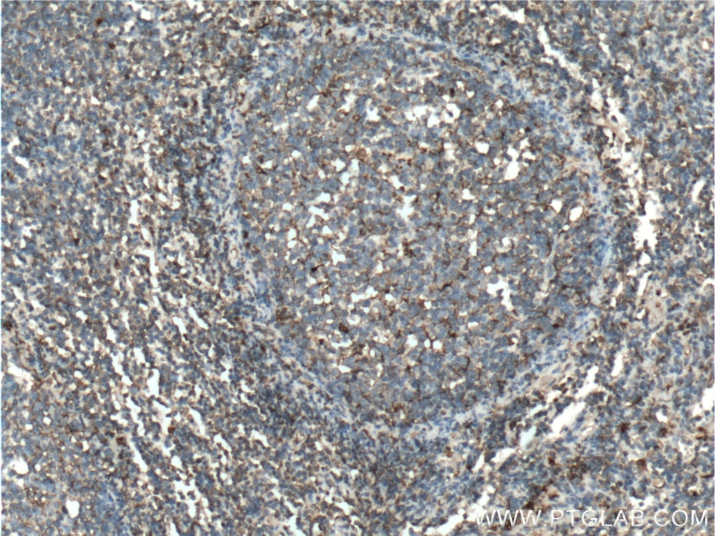 Immunohistochemistry (IHC) staining of human tonsillitis tissue using Alpha Antichymotrypsin Polyclonal antibody (12192-1-AP)