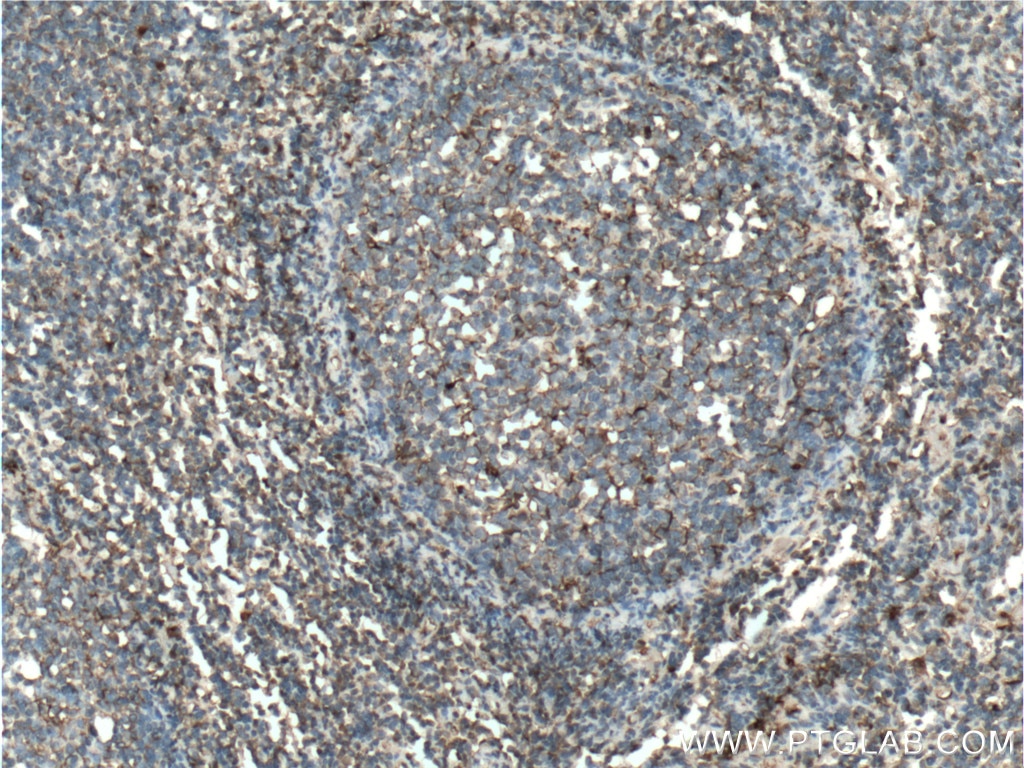 IHC staining of human tonsillitis using 12192-1-AP