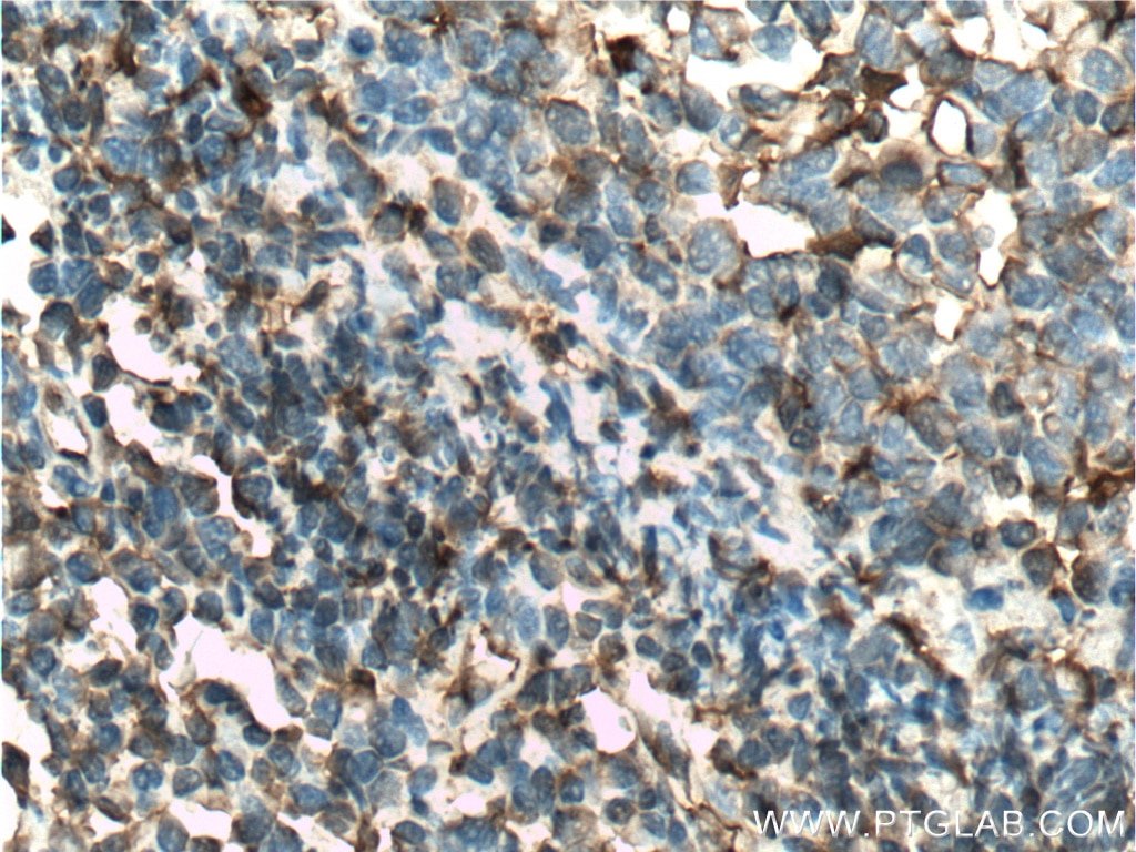Immunohistochemistry (IHC) staining of human tonsillitis tissue using Alpha Antichymotrypsin Polyclonal antibody (12192-1-AP)