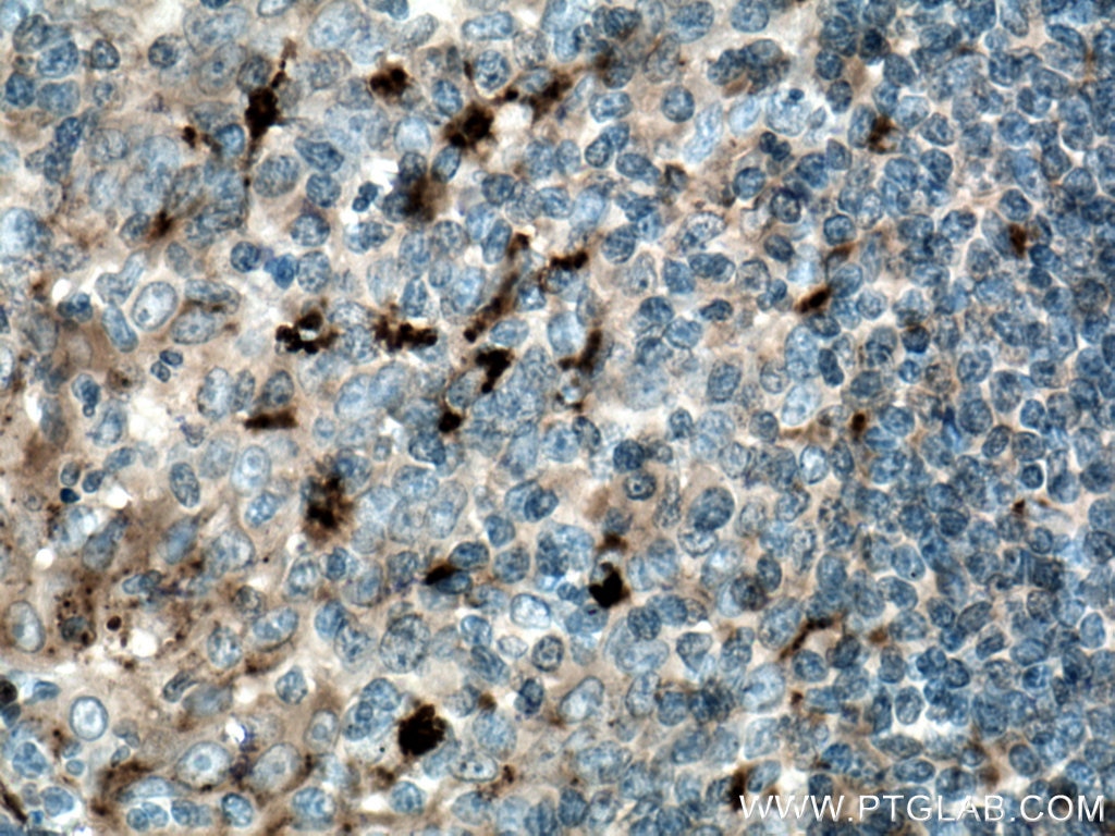 Immunohistochemistry (IHC) staining of human tonsillitis tissue using Alpha Antichymotrypsin Monoclonal antibody (66078-1-Ig)