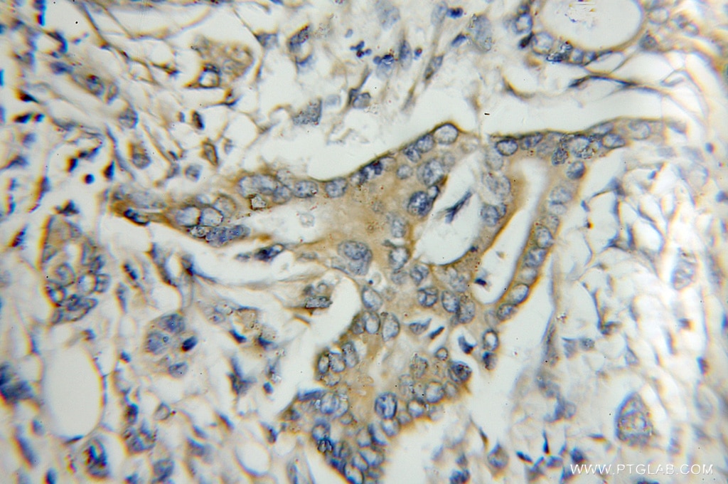 Immunohistochemistry (IHC) staining of human pancreas cancer tissue using Kallistatin Polyclonal antibody (11430-2-AP)