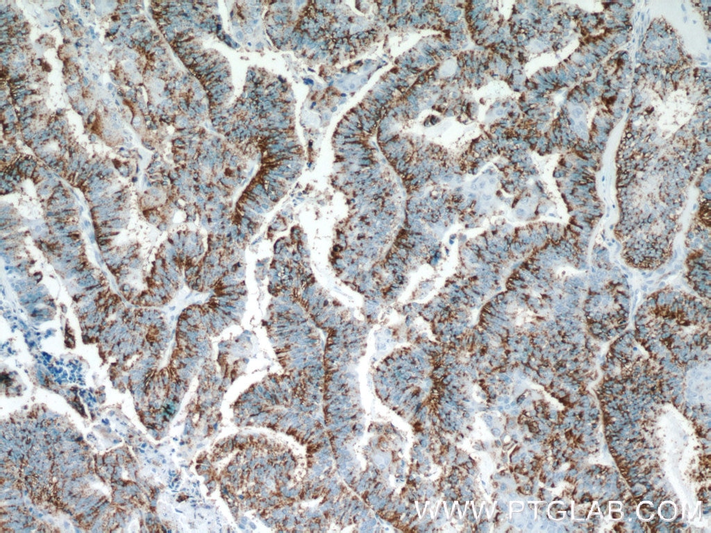 Immunohistochemistry (IHC) staining of human ovary tumor tissue using Protein C inhibitor Polyclonal antibody (10673-1-AP)