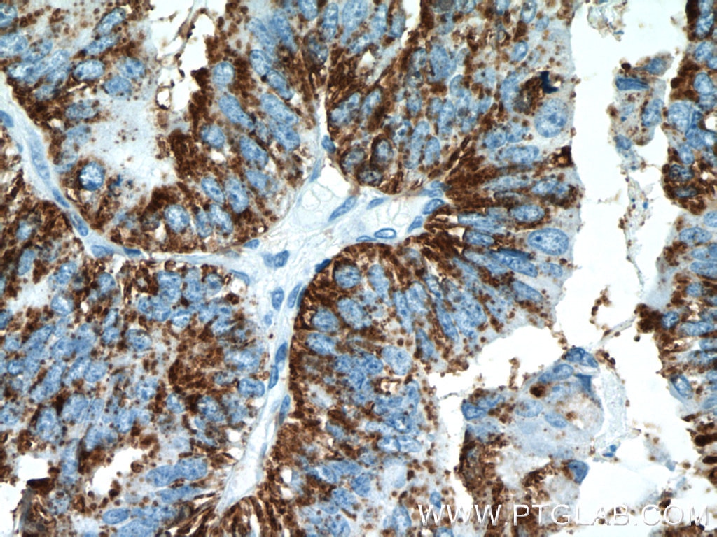 Immunohistochemistry (IHC) staining of human ovary tumor tissue using Protein C inhibitor Polyclonal antibody (10673-1-AP)