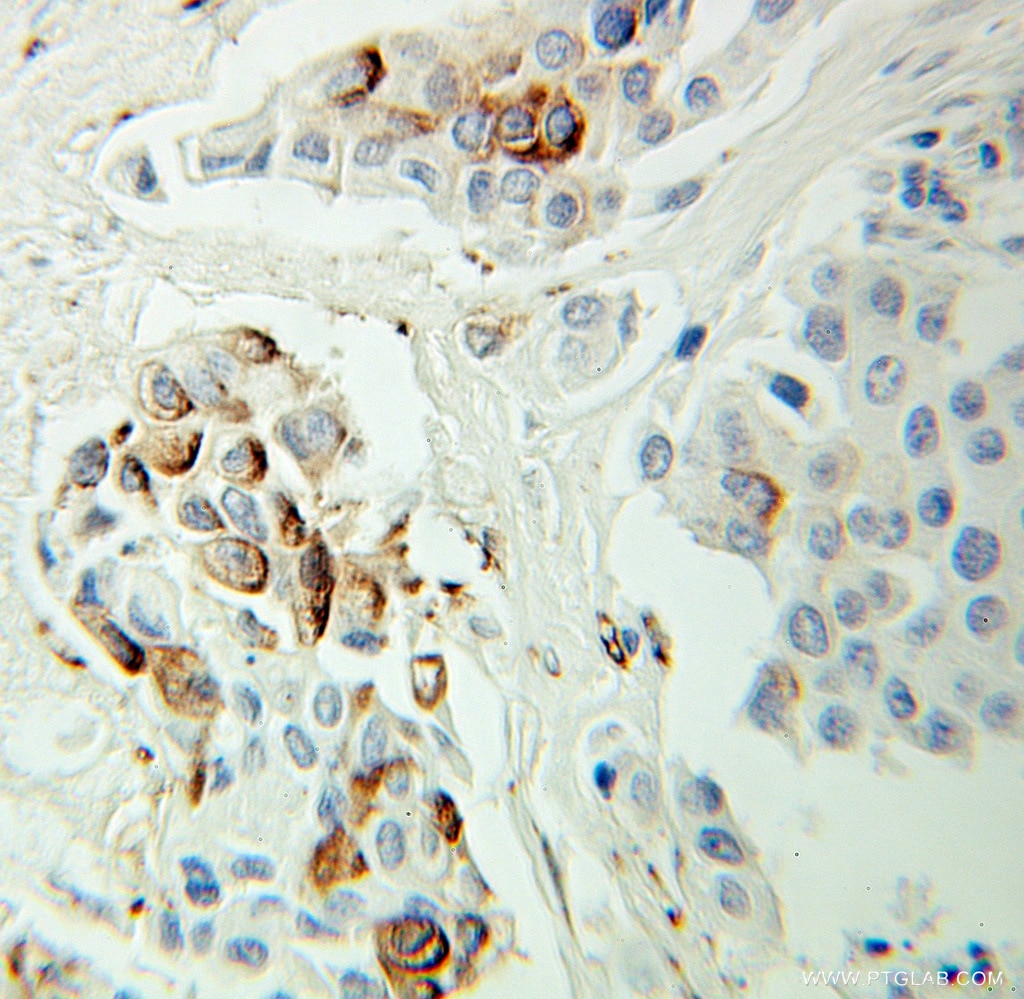 Immunohistochemistry (IHC) staining of human breast cancer tissue using Protein C inhibitor Polyclonal antibody (10673-1-AP)