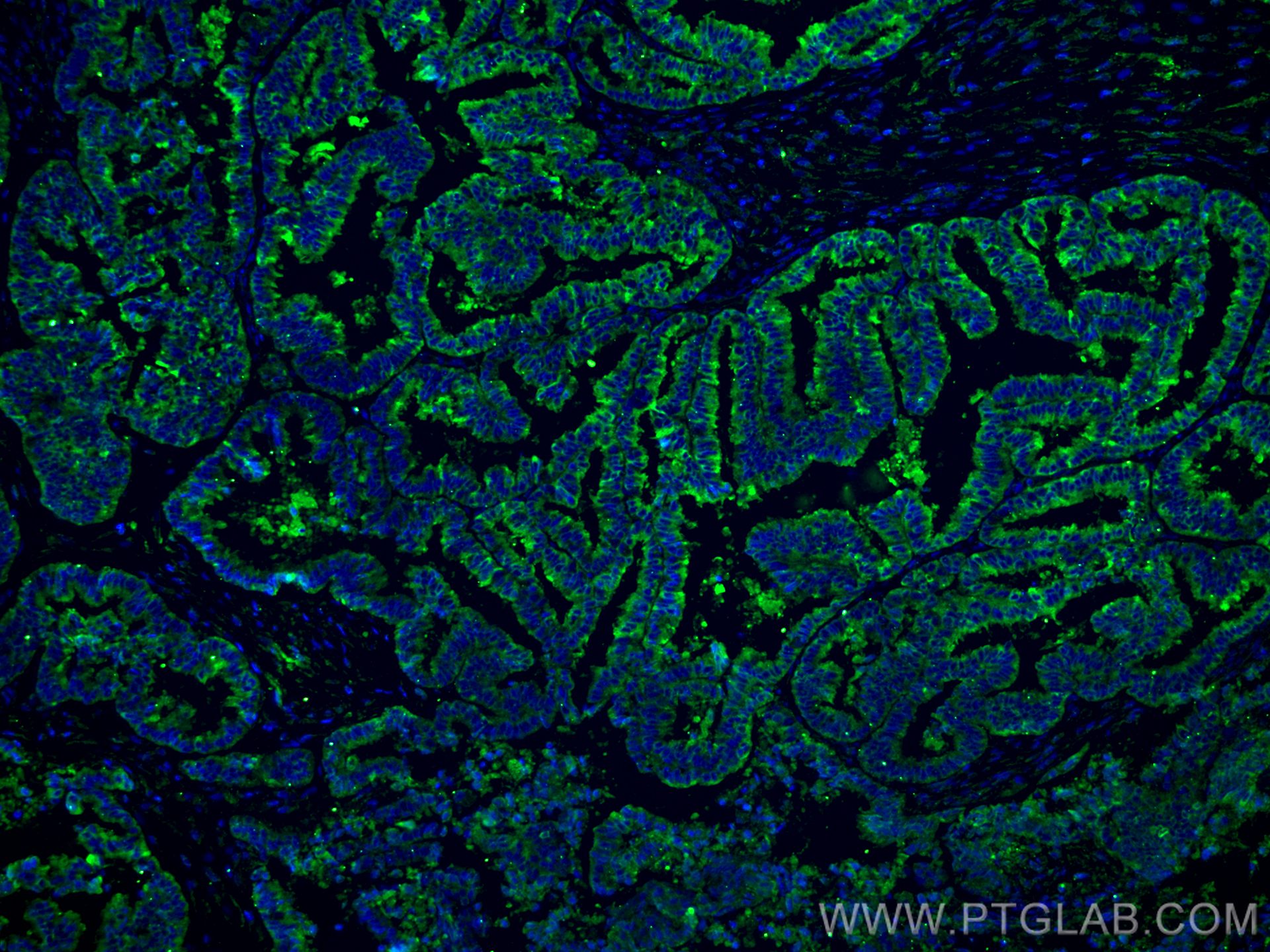 Immunofluorescence (IF) / fluorescent staining of human ovary tumor tissue using Protein C inhibitor Monoclonal antibody (66030-1-Ig)