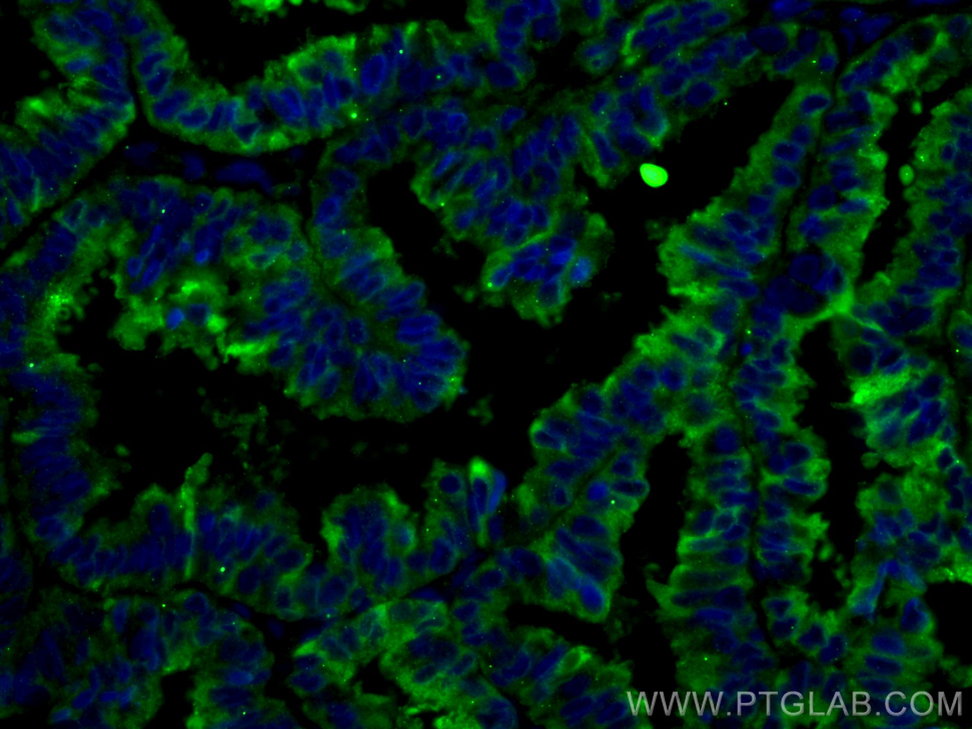 IF Staining of human ovary tumor using 66030-1-Ig