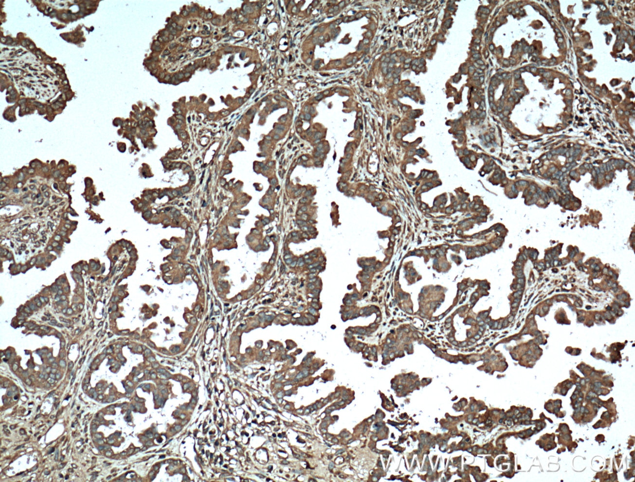 Immunohistochemistry (IHC) staining of human ovary tumor tissue using Protein C inhibitor Monoclonal antibody (66030-1-Ig)
