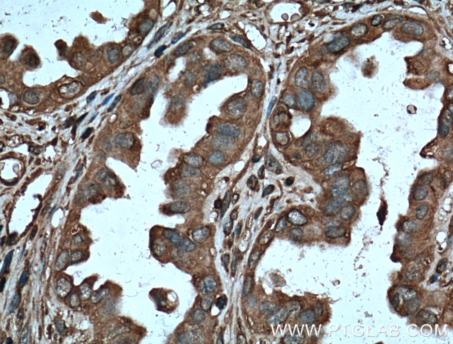 Immunohistochemistry (IHC) staining of human ovary tumor tissue using Protein C inhibitor Monoclonal antibody (66030-1-Ig)