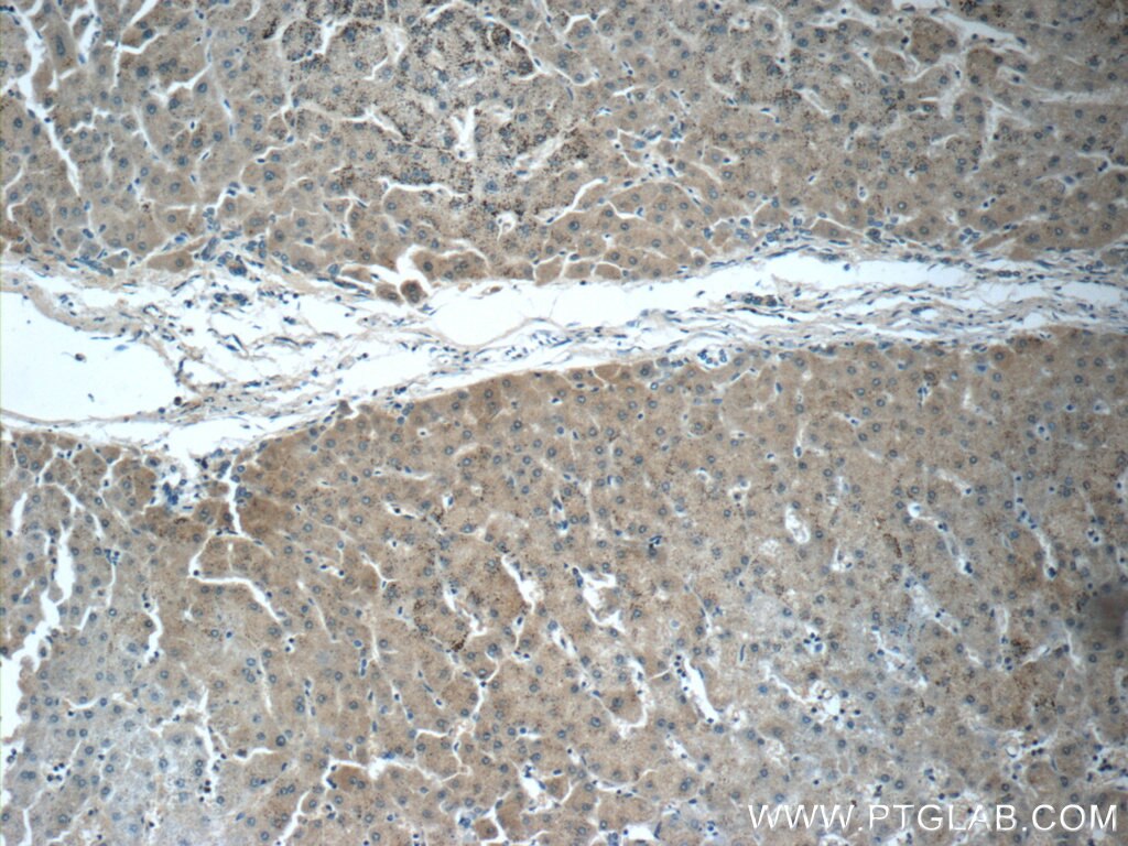 Immunohistochemistry (IHC) staining of human hepatocirrhosis tissue using SERPINA6/CBG Polyclonal antibody (12010-1-AP)