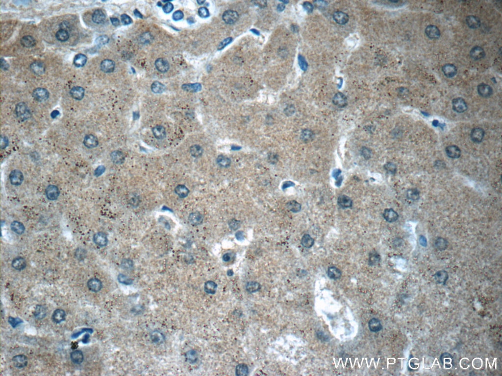 Immunohistochemistry (IHC) staining of human hepatocirrhosis tissue using SERPINA6/CBG Polyclonal antibody (12010-1-AP)