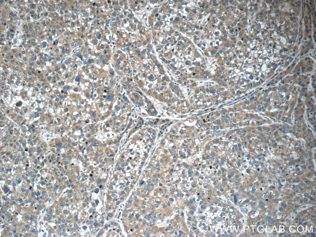 Immunohistochemistry (IHC) staining of human liver cancer tissue using SERPINA6/CBG Polyclonal antibody (12010-1-AP)