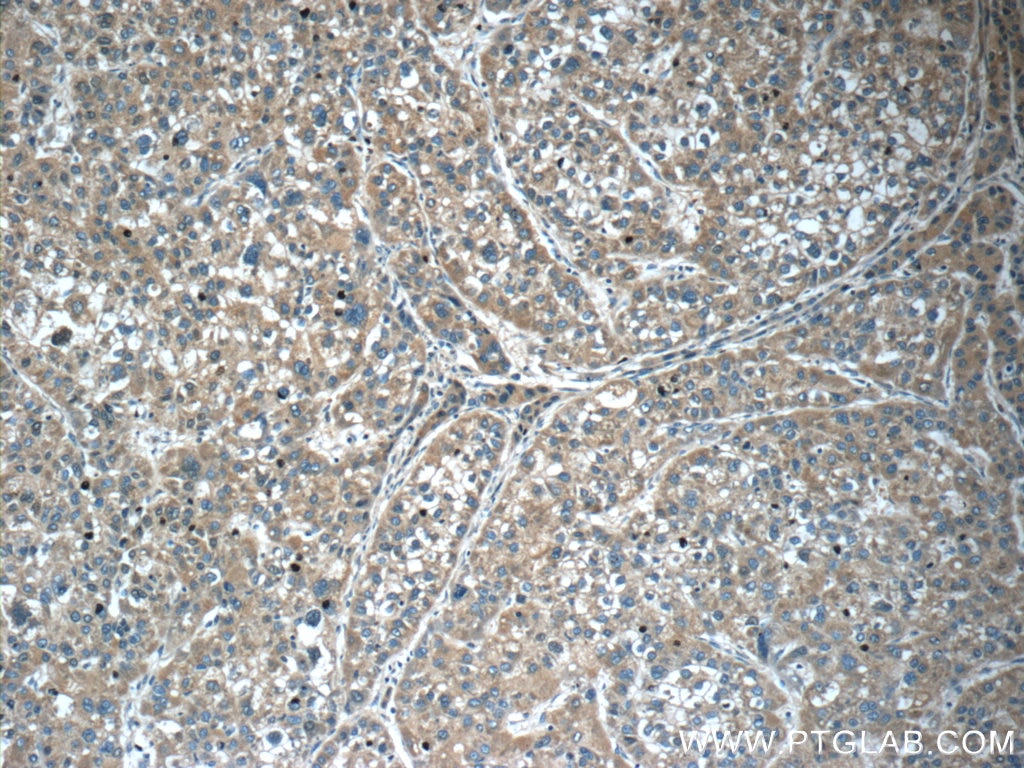 Immunohistochemistry (IHC) staining of human liver cancer tissue using SERPINA6/CBG Polyclonal antibody (12010-1-AP)