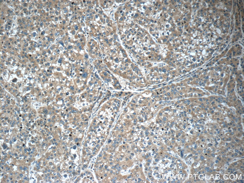 IHC staining of human liver cancer using 12010-1-AP