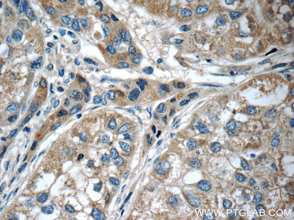 IHC staining of human liver cancer using 12010-1-AP