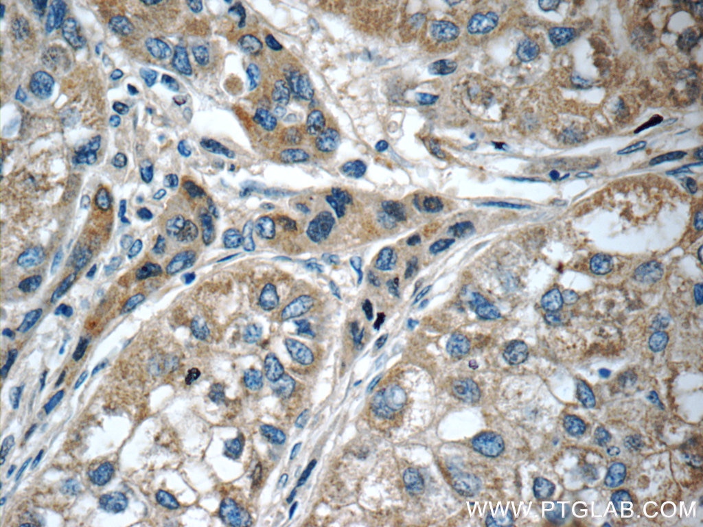 Immunohistochemistry (IHC) staining of human liver cancer tissue using SERPINA6/CBG Polyclonal antibody (12010-1-AP)