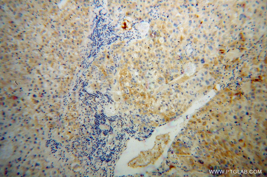 Immunohistochemistry (IHC) staining of human liver cancer tissue using SERPINA6/CBG Polyclonal antibody (12010-1-AP)