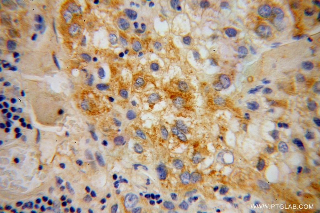 Immunohistochemistry (IHC) staining of human liver cancer tissue using SERPINA6/CBG Polyclonal antibody (12010-1-AP)