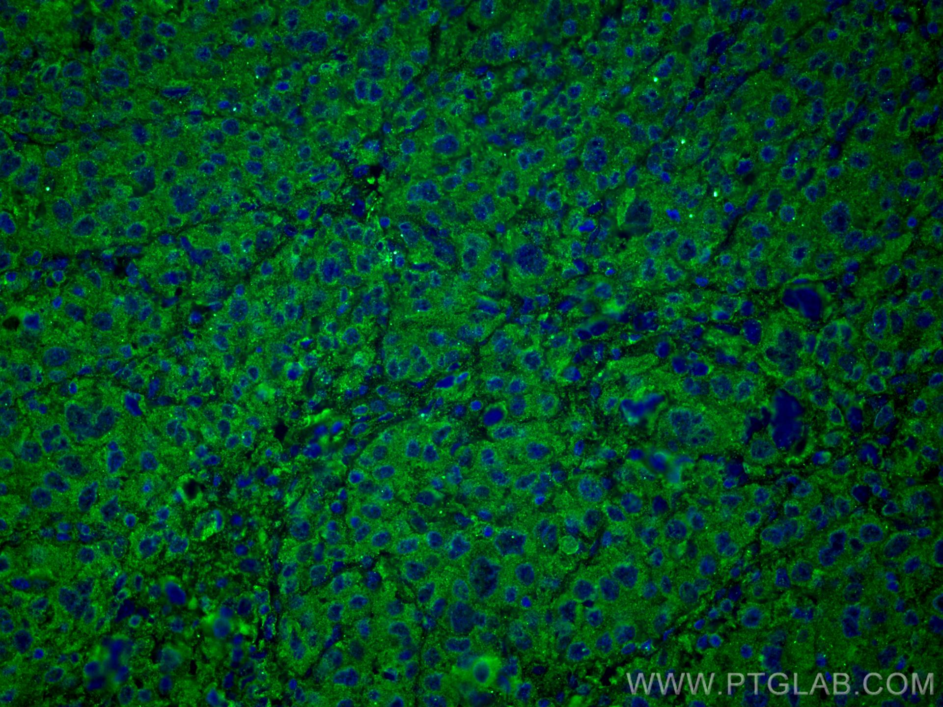 Immunofluorescence (IF) / fluorescent staining of human liver cancer tissue using SERPINA7 Monoclonal antibody (66454-1-Ig)