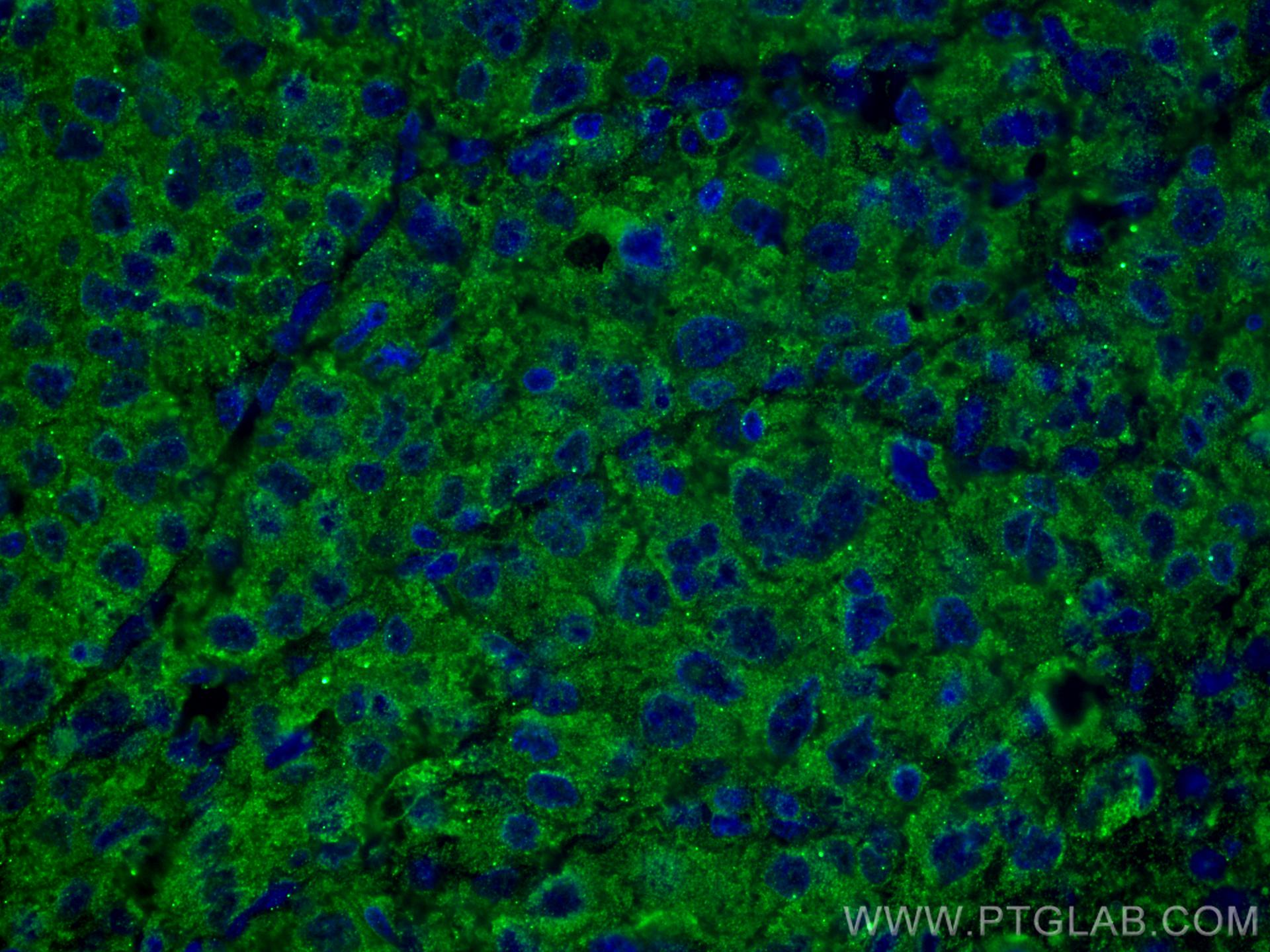 Immunofluorescence (IF) / fluorescent staining of human liver cancer tissue using SERPINA7 Monoclonal antibody (66454-1-Ig)
