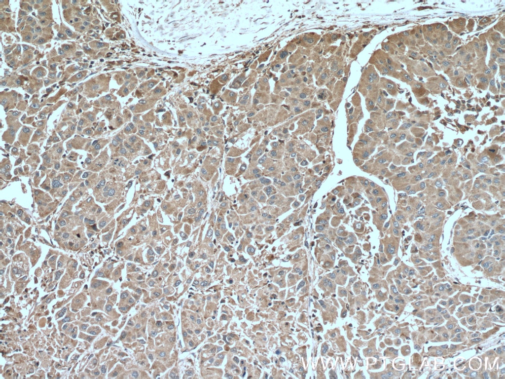 Immunohistochemistry (IHC) staining of human liver cancer tissue using SERPINA7 Monoclonal antibody (66454-1-Ig)