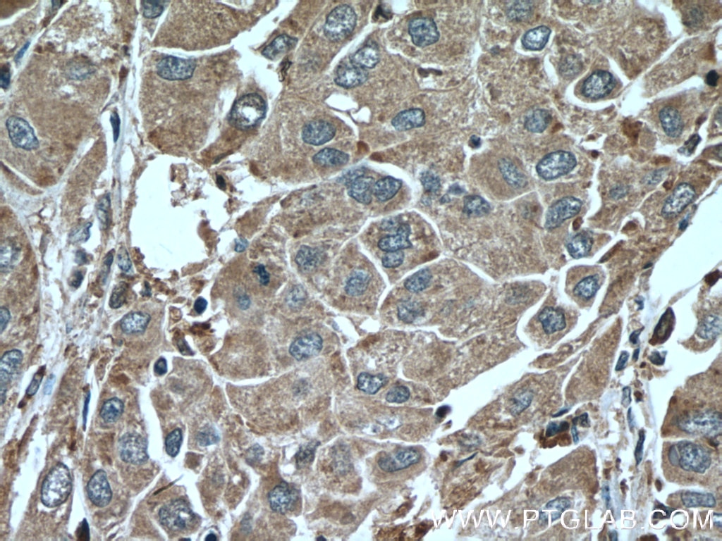 Immunohistochemistry (IHC) staining of human liver cancer tissue using SERPINA7 Monoclonal antibody (66454-1-Ig)