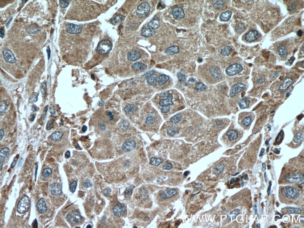 IHC staining of human liver cancer using 66454-1-Ig