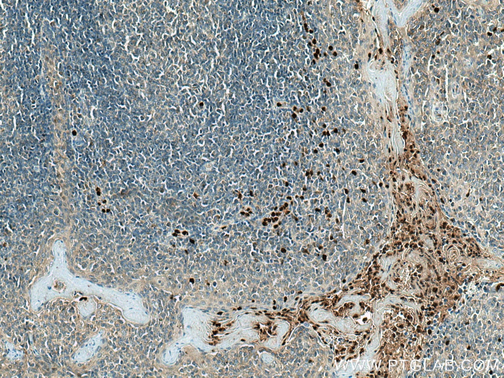 Immunohistochemistry (IHC) staining of human tonsillitis tissue using SERPINB10 Polyclonal antibody (21719-1-AP)