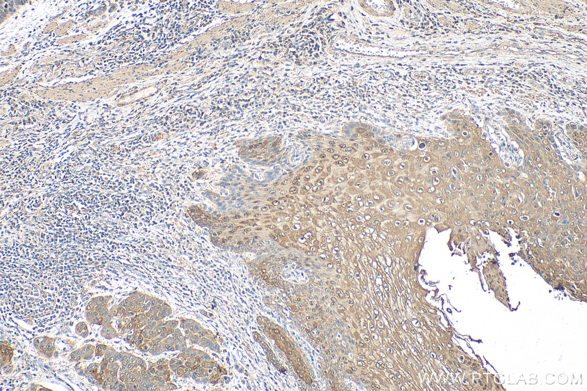 Immunohistochemistry (IHC) staining of human oesophagus cancer tissue using SERPINB13 Polyclonal antibody (18045-1-AP)