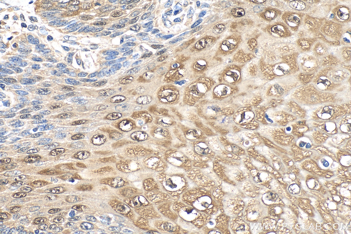 Immunohistochemistry (IHC) staining of human oesophagus cancer tissue using SERPINB13 Polyclonal antibody (18045-1-AP)