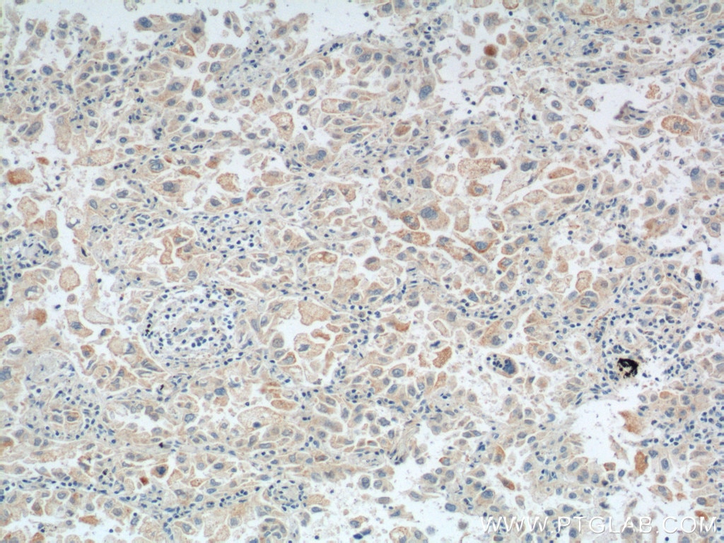 Immunohistochemistry (IHC) staining of human lung cancer tissue using Maspin Polyclonal antibody (11722-1-AP)