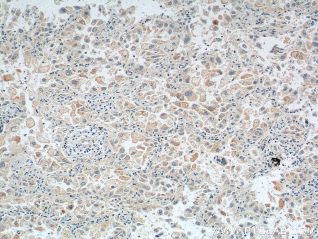 IHC staining of human lung cancer using 11722-1-AP