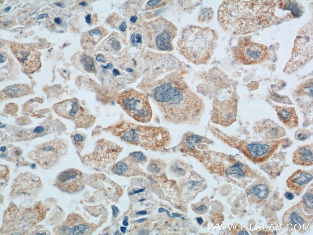 Immunohistochemistry (IHC) staining of human lung cancer tissue using Maspin Polyclonal antibody (11722-1-AP)