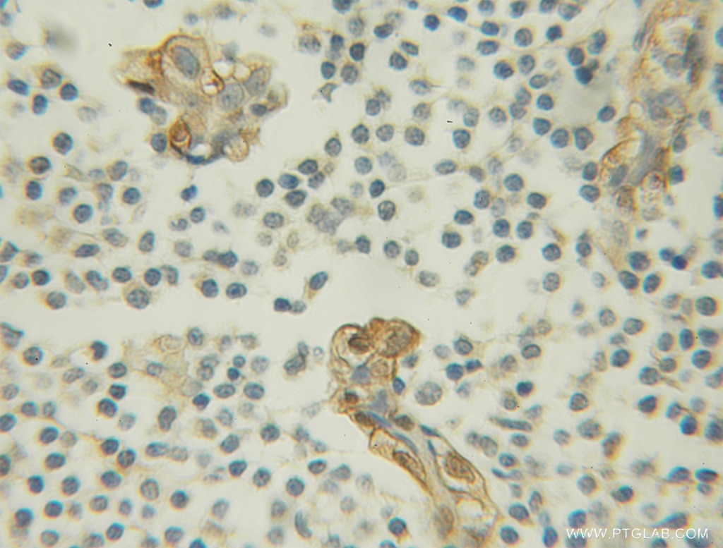 Immunohistochemistry (IHC) staining of human breast cancer tissue using Maspin Polyclonal antibody (11722-1-AP)
