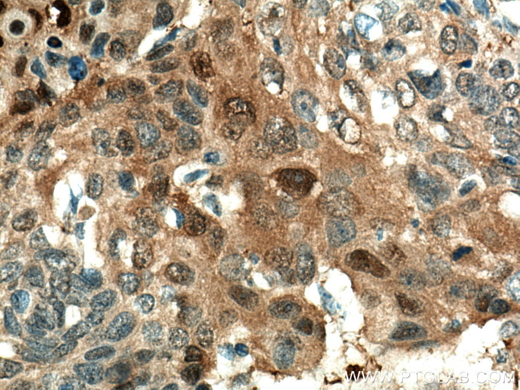 Immunohistochemistry (IHC) staining of human oesophagus cancer tissue using Maspin Monoclonal antibody (67633-1-Ig)