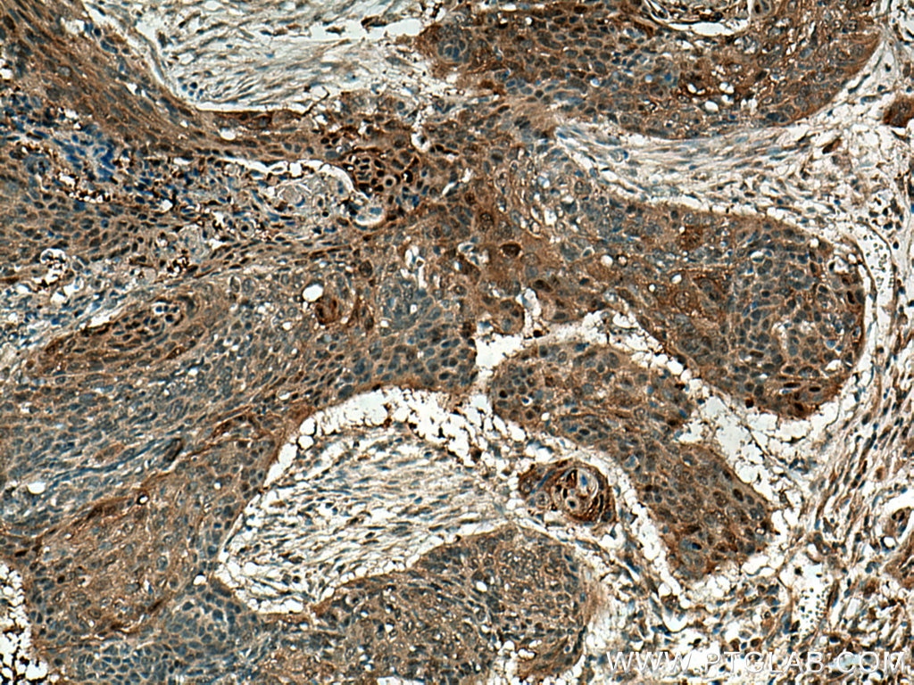 Immunohistochemistry (IHC) staining of human oesophagus cancer tissue using Maspin Monoclonal antibody (67633-1-Ig)