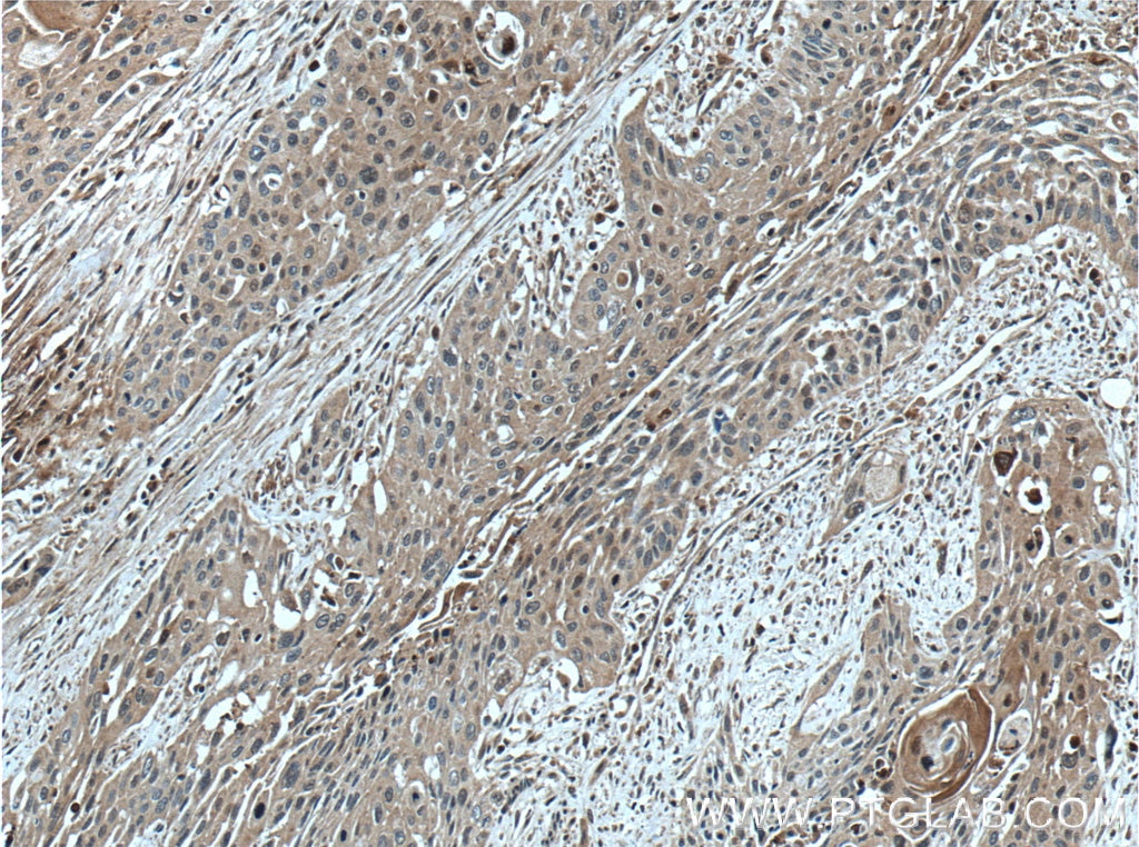Immunohistochemistry (IHC) staining of human oesophagus cancer tissue using SERPINB8 Polyclonal antibody (13102-2-AP)