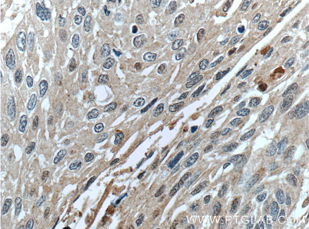 Immunohistochemistry (IHC) staining of human oesophagus cancer tissue using SERPINB8 Polyclonal antibody (13102-2-AP)