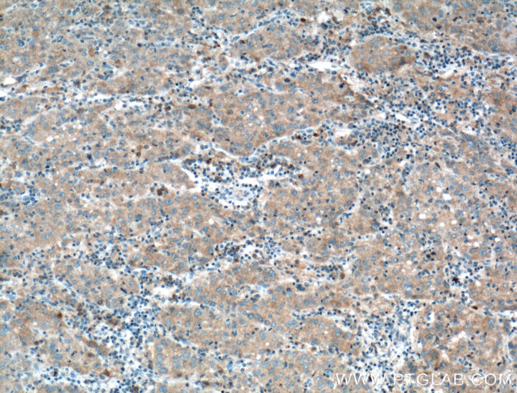 Immunohistochemistry (IHC) staining of human liver cancer tissue using Serpin C1/Antithrombin III Monoclonal antibody (66052-1-Ig)