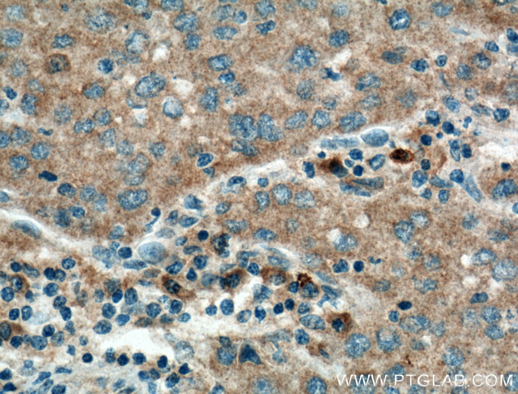 Immunohistochemistry (IHC) staining of human liver cancer tissue using Serpin C1/Antithrombin III Monoclonal antibody (66052-1-Ig)