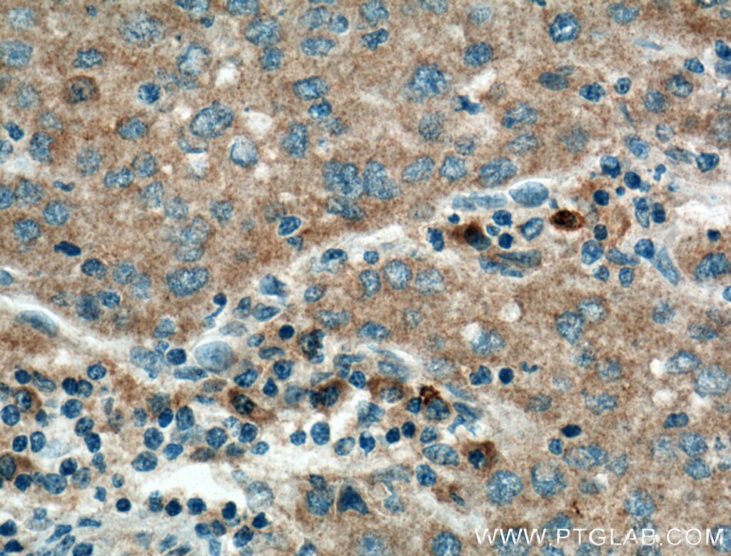 IHC staining of human liver cancer using 66052-1-Ig