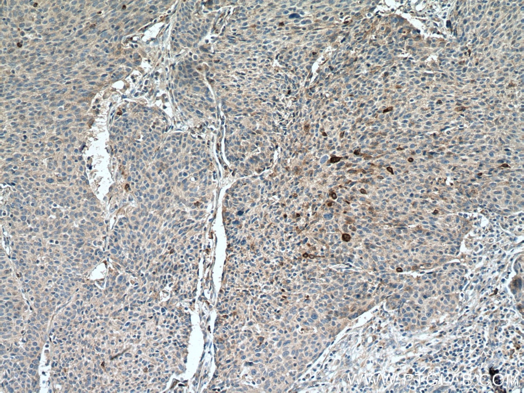 Immunohistochemistry (IHC) staining of human lung cancer tissue using PAI-1 Polyclonal antibody (13801-1-AP)