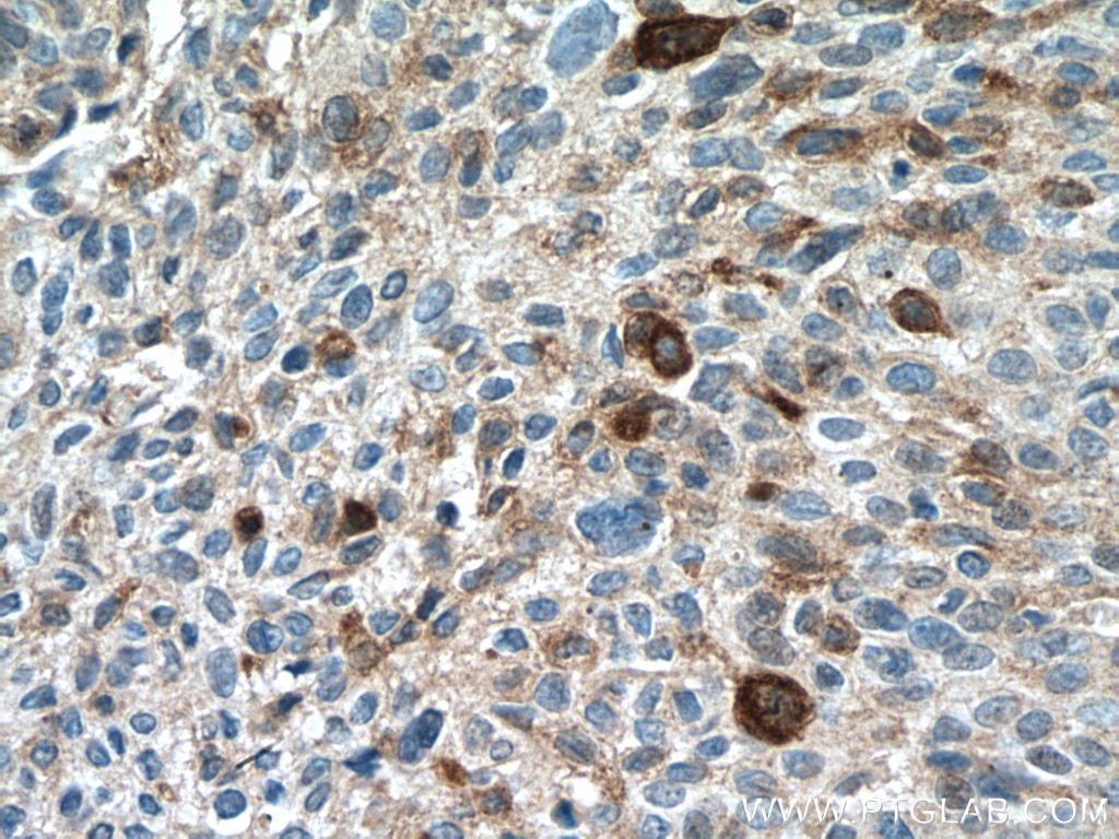 Immunohistochemistry (IHC) staining of human lung cancer tissue using PAI-1 Polyclonal antibody (13801-1-AP)