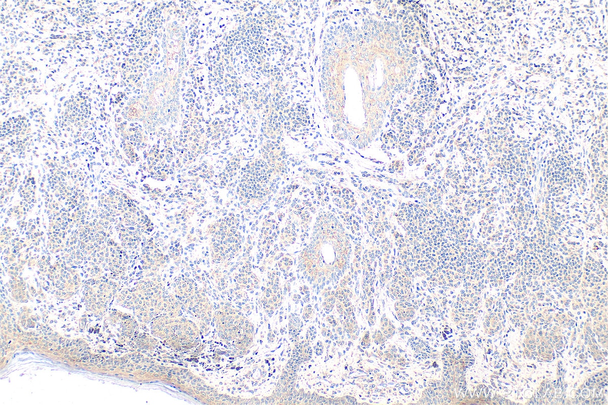 Immunohistochemistry (IHC) staining of human malignant melanoma tissue using Serpin E1/PAI-1 Polyclonal antibody (13801-1-AP)
