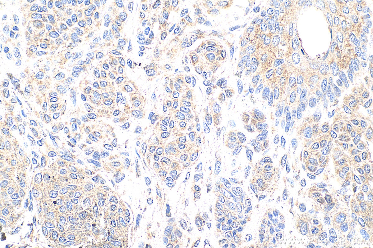 Immunohistochemistry (IHC) staining of human malignant melanoma tissue using Serpin E1/PAI-1 Polyclonal antibody (13801-1-AP)